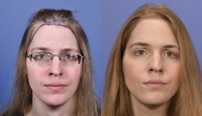 Hair Transplant before and after photo