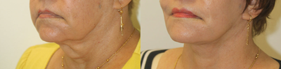 Neck Lift before and after photo