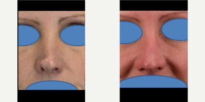 Revision Rhinoplasty before and after photo