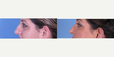Rhinoplasty before and after photo