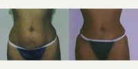 Tummy Tuck before and after photo