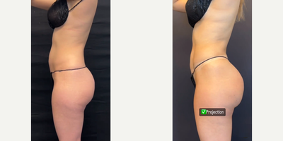 Brazilian Butt Lift before and after photo
