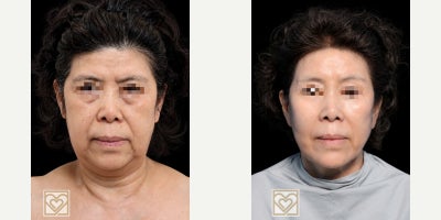 Deep Plane Facelift before and after photo