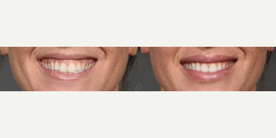 Dermal Fillers before and after photo