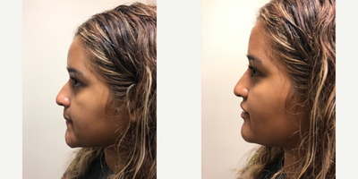 Voluma before and after photo