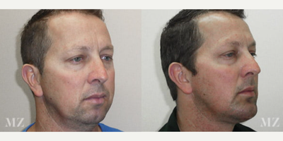 Chin Implant before and after photo
