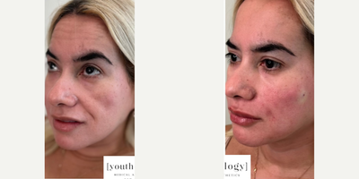 Dermal Fillers before and after photo