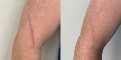 IPL before and after photo