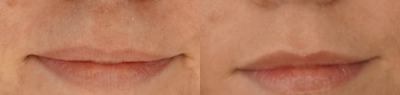 Jeuveau before and after photo