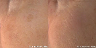 Mole Removal before and after photo