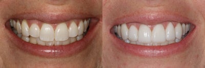 Porcelain Veneers before and after photo