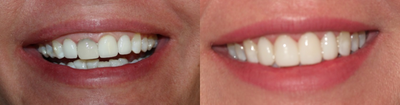 Smile Makeover before and after photo