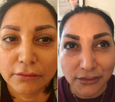 CO2 Laser before and after photo