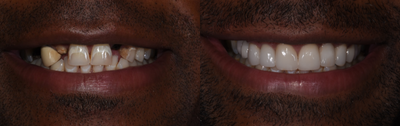 Dental Implants before and after photo