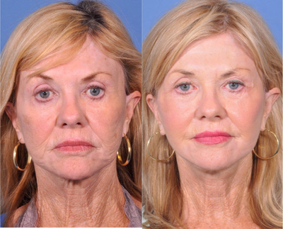 Facelift before and after photo
