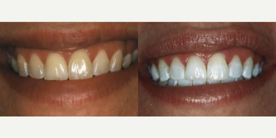Teeth Whitening before and after photo