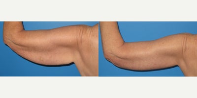 Arm Lift before and after photo