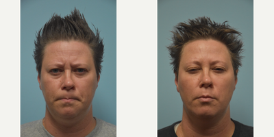 Botox before and after photo
