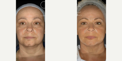 Dermal Fillers before and after photo