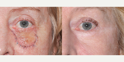 Facial Reconstructive Surgery before and after photo