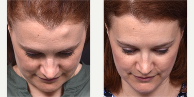 Lipoma Removal before and after photo