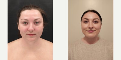 Neck Lift before and after photo