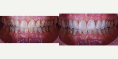 Porcelain Veneers before and after photo
