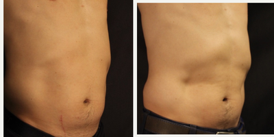 SculpSure before and after photo