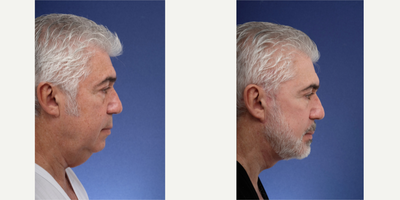 Facelift before and after photo