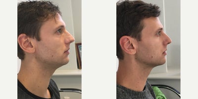 Kybella before and after photo