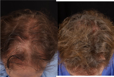 NeoGraft before and after photo