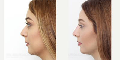 Nonsurgical Nose Job before and after photo