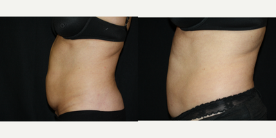 CoolSculpting before and after photo