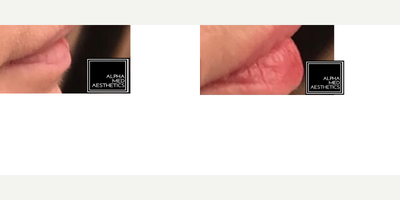 Lip Fillers before and after photo