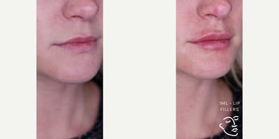 Lip Fillers before and after photo