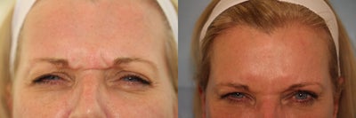 Botox before and after photo