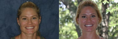 Da Vinci Veneers before and after photo