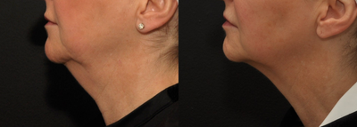 Kybella before and after photo