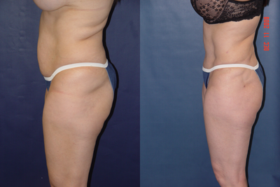 Liposculpture before and after photo