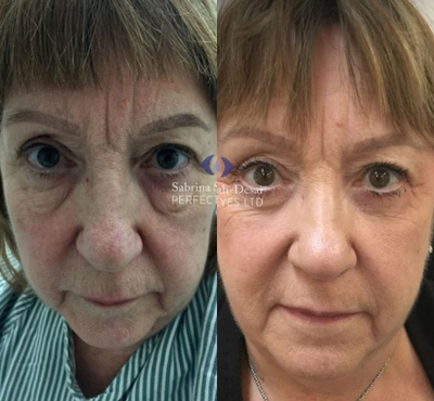 Eyelid Surgery before and after photo