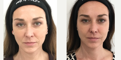 Skin Tightening before and after photo