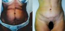 Tummy Tuck before and after photo