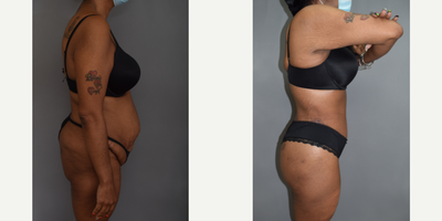 Body Lift before and after photo