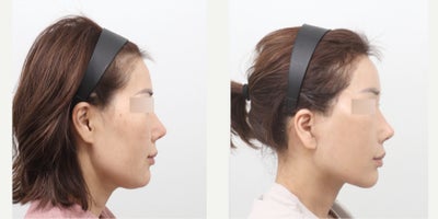 Brow Lift before and after photo