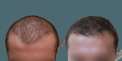 Hair Transplant before and after photo