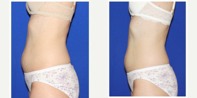 UltraShape before and after photo