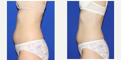 UltraShape before and after photo