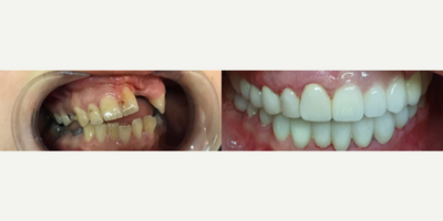 Dental Crown before and after photo