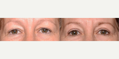 Eyelid Surgery before and after photo