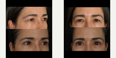 Eyelid Surgery before and after photo